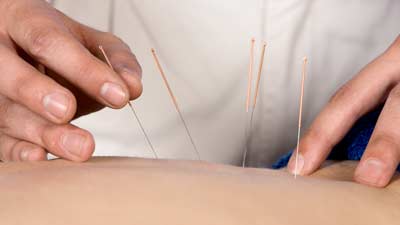 Acupuncture treatment with needles